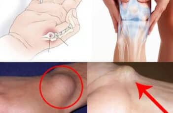 Cisti al piede polso