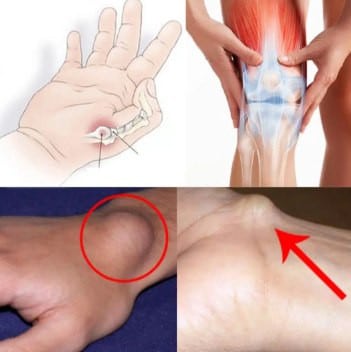 Cisti al piede polso