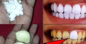 aglio sbiancamento denti naturale