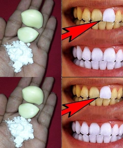 aglio sbiancamento denti naturale
