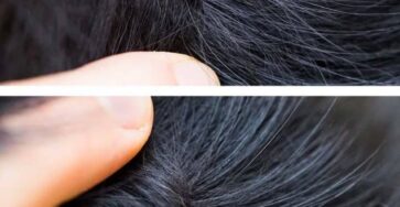 parassiti nei capelli