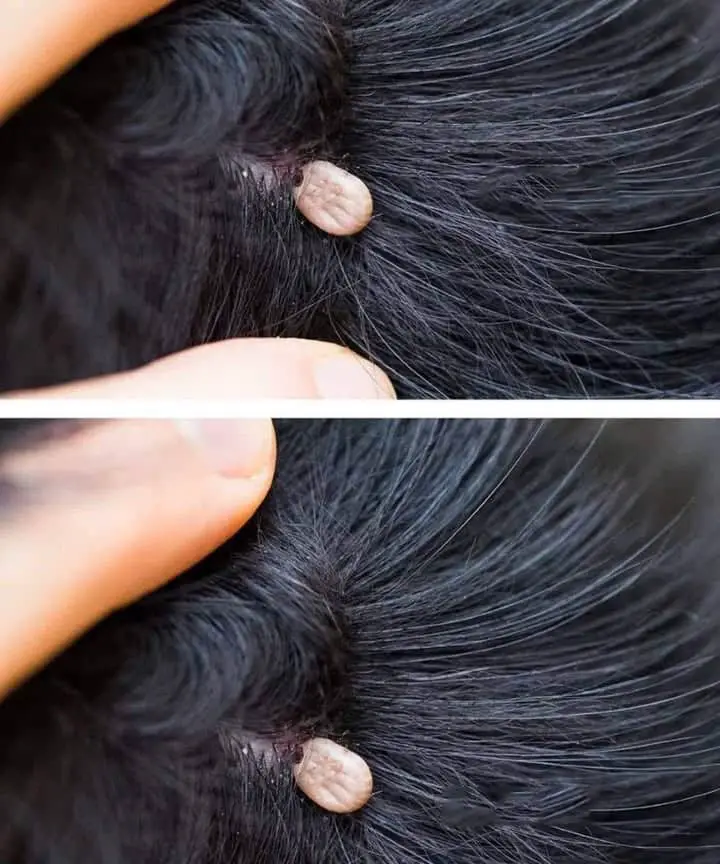 parassiti nei capelli
