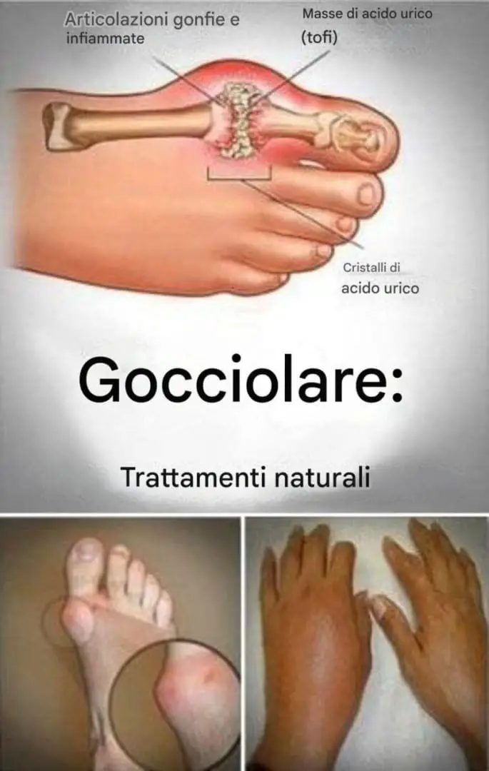 rimedi naturali gotta