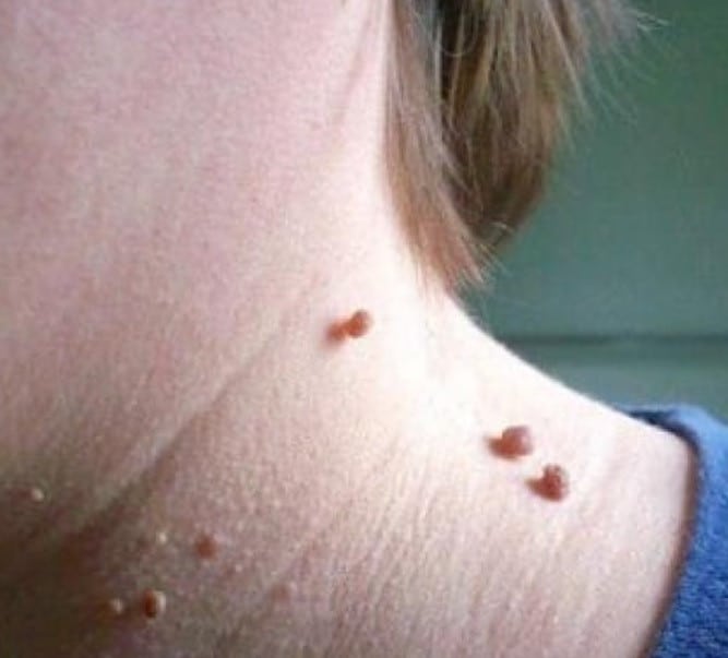 rimuovere piccole verruche pelle