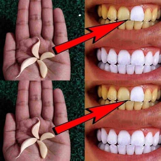 sbiancare denti aglio metodo