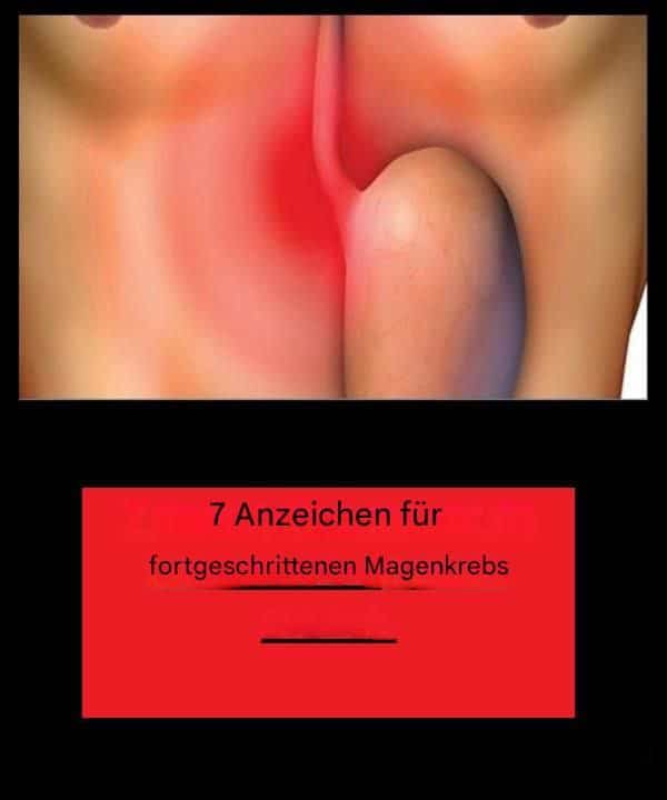 sette segni cancro stomaco
