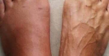 sintomi infarto avvisano corpo