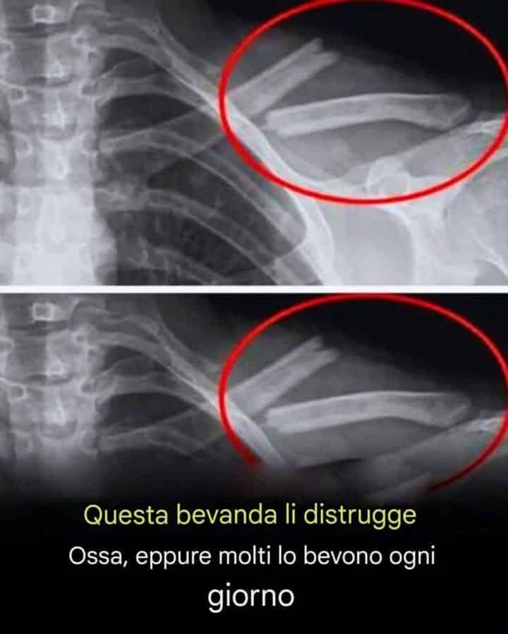 Bevanda distrugge le ossa