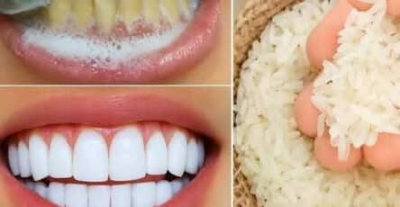 Sbiancamento dei denti veloce
