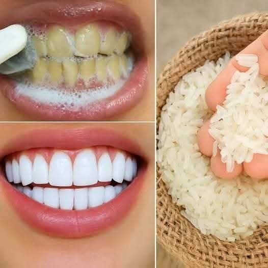 Sbiancamento dei denti veloce