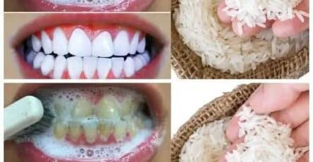 Sbiancamento dentale veloce