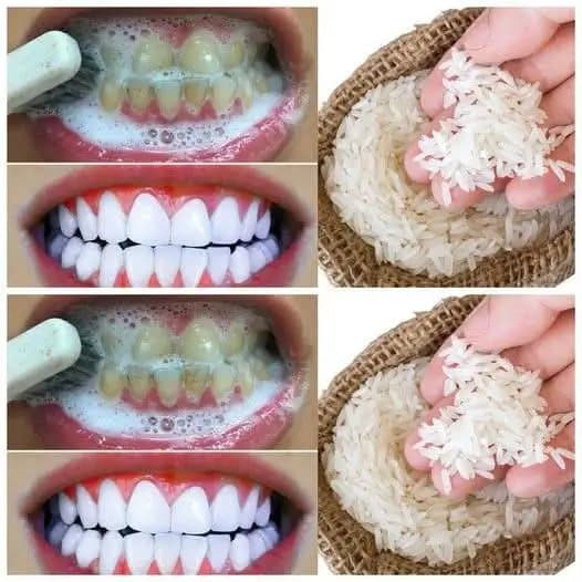 Sbiancamento dentale veloce