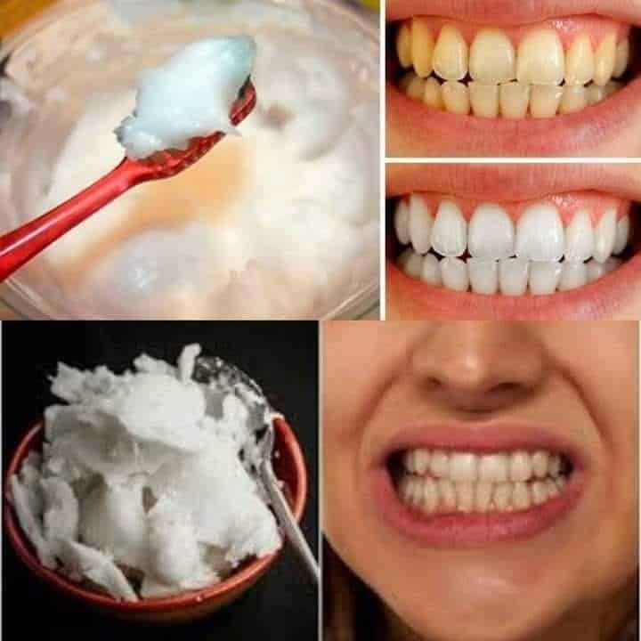 Sbiancare i denti naturalmente