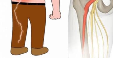 alleviare dolore sciatico gambe