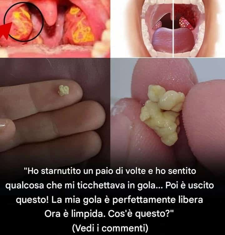 cause tonsille bianche gialle