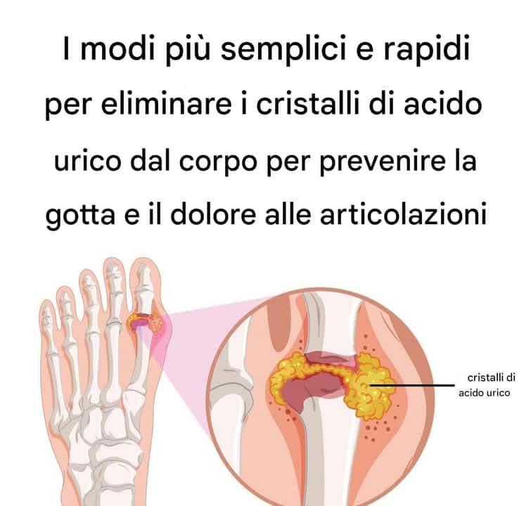cristallizzazione acido urico