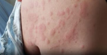 orticarie allergie corpo