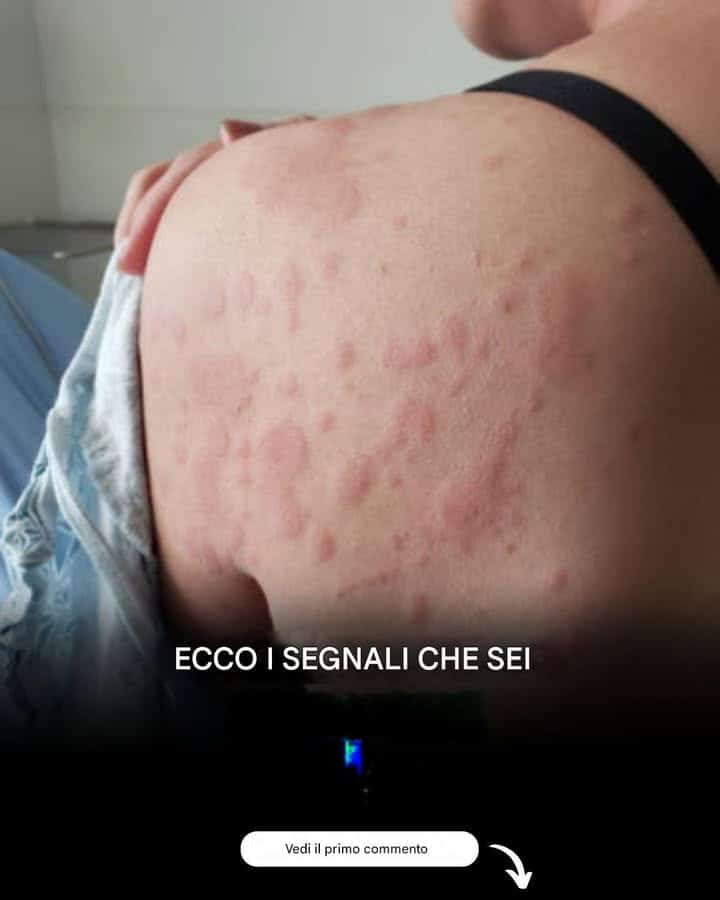 orticarie allergie corpo