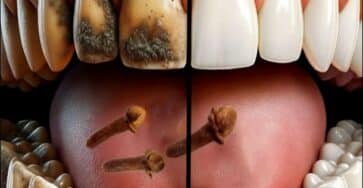 sbiancamento denti casa