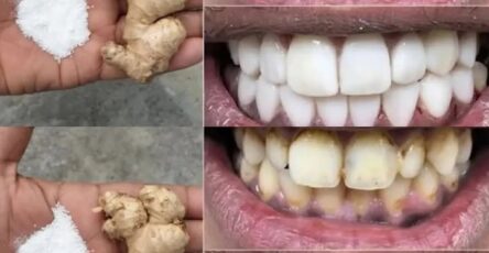 sbiancamento denti veloce naturale