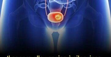 segnali di cancro vescica