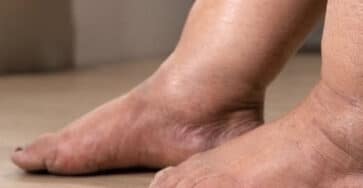 tè per gambe gonfie
