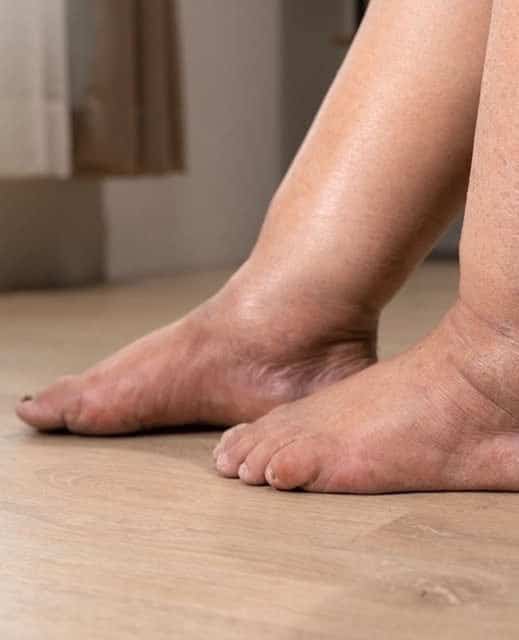 tè per gambe gonfie
