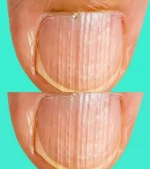 unghie a strisce significato