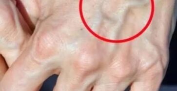 vene visibili significano salute